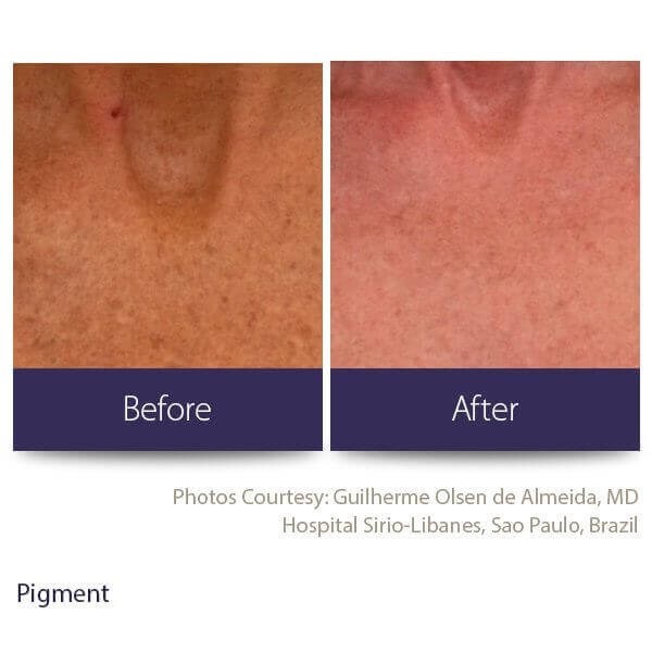A before and after photo of the results of hyperpigmentation treatments