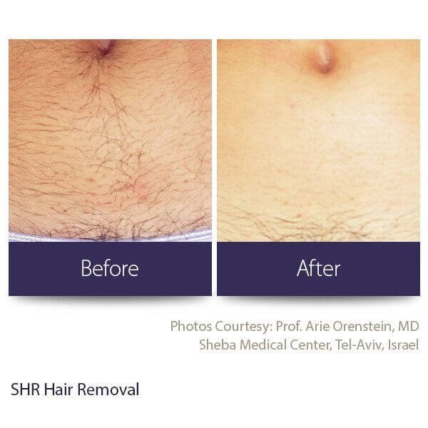 A before and after photo showing the results of laser hair removal