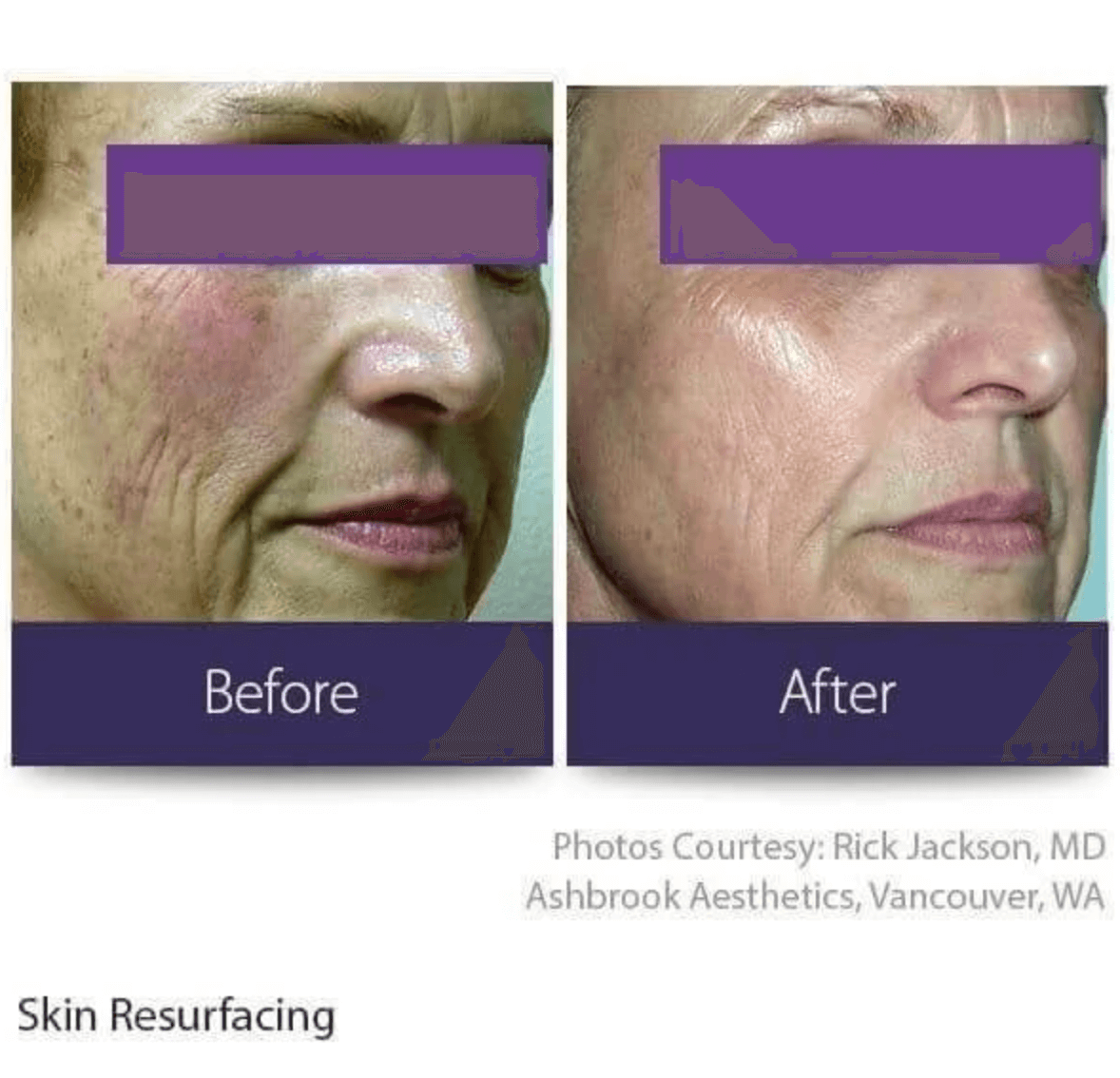 A before and after photo showing the effects of laser skin resurfacing